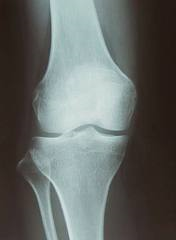膝のレントゲン