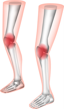 膝の痛み